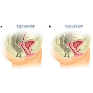 Vesicovaginal or ureterovaginal fistulas after pelvic surgery